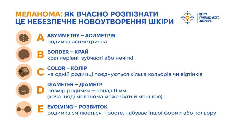 Меланома: як вчасно розпізнати це небезпечне новоутворення шкіри